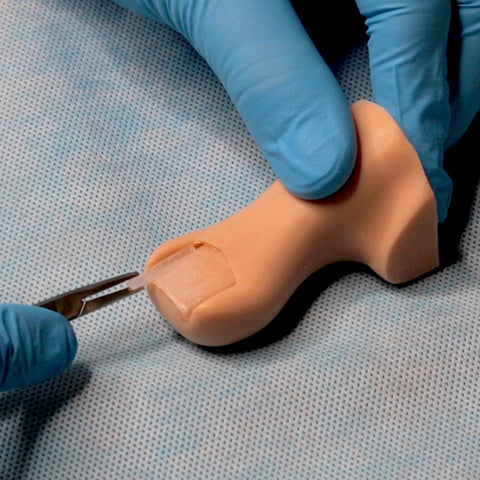 Removing a Dead Toenail - Toenail Removal Surgery Video
